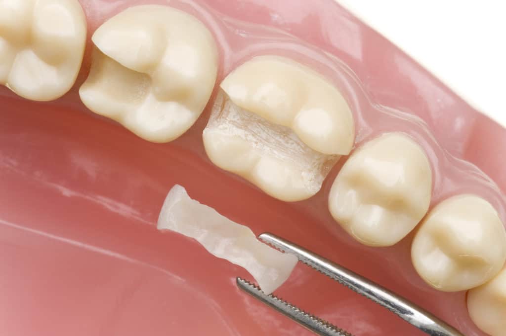 Inlay - ästhetische Zahnmedizin
